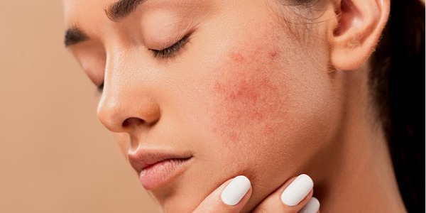 Desvelando el misterio de la dermatitis seborreica: Causas, síntomas y soluciones